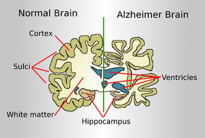 Brain Alzheimer