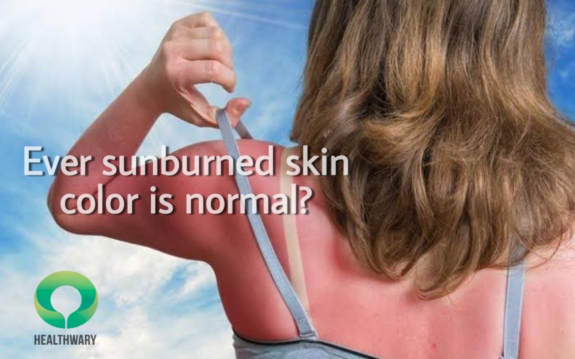 Ever sunburned skin color is normal?