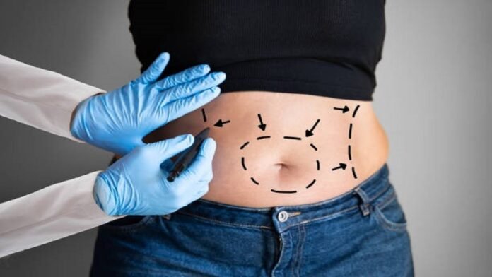 How much Weight can You Lose with a Full Tummy Tuck